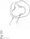 Fig. 33 - METHOD OF FITTING A PROSTHETIC INTERFACE SYSTEM USING COMPLIANT MEMBERS