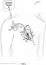 Fig. 02 - IMPLANTABLE MEDICAL DEVICE WITH PACING CAPTURE CLASSIFICATION