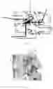 Fig. 02 - LUMBAR FACETECTOMY GUIDE
