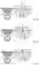 Fig. 05 - NOVEL SURGICAL METHODS FOR THE TREATMENT OF SPINAL STENOSIS