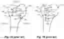 Fig. 02 - Guided growth device and method