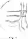 Fig. 02 - Methods and devices for semi-rigid bone fixation