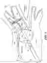 Fig. 08 - Real-time lesion formation assessment