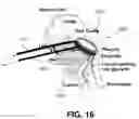 Fig. 22 - SYSTEMS AND METHODS FOR TREATMENT OF OBSTRUCTIVE SLEEP APNEA