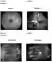 Fig. 07 - Methods of inhibiting pathological angiogenesis