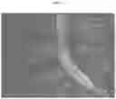 Fig. 10 - METHODS AND COMPOSITIONS TO FACILITATE REPAIR OF AVASCULAR TISSUE