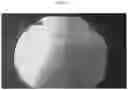 Fig. 15 - METHODS AND COMPOSITIONS TO FACILITATE REPAIR OF AVASCULAR TISSUE