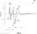 Fig. 05 - Hysteresis compensation for detection of ECAPs