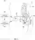 Fig. 02 - Autotitration of therapy using detected electrical activity