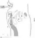 Fig. 03 - Autotitration of therapy using detected electrical activity