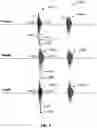 Fig. 05 - Method and device for controlling cardiac resynchronization therapy based on heart sounds