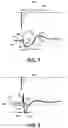 Fig. 09 - HIS-PURKINJE SYSTEM CAPTURE DETECTION