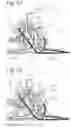 Fig. 33 - SET OF COUPLING ASSEMBLIES FOR A BOARD FOR BOARD SPORTS