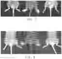 Fig. 08 - PATIENT SELECTION METHOD FOR INFLAMMATION