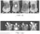 Fig. 09 - PATIENT SELECTION METHOD FOR INFLAMMATION