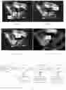 Fig. 05 - Method for measuring parameters in ultrasonic image and ultrasonic imaging system