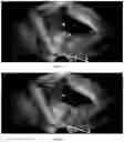 Fig. 12 - Method for measuring parameters in ultrasonic image and ultrasonic imaging system