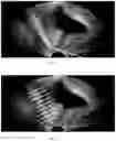 Fig. 13 - Method for measuring parameters in ultrasonic image and ultrasonic imaging system