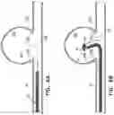 Fig. 07 - Devices for treating vascular malformations