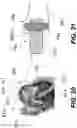 Fig. 20 - PERCUTANEOUS RETROGRADE THERAPY FOR PULMONARY EMBOLISM