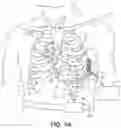 Fig. 02 - Ventricular assist device and cardiac electrical stimulation system for therapy control