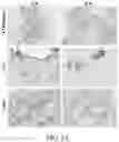 Fig. 10 - CANCER DETECTION UTILIZING NORMAL TISSUE ADJACENT TO BREAST TUMORS WITH GENETIC ANCESTRY-MAPPING
