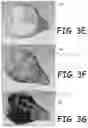 Fig. 06 - MODEL OBJECT FOR VISUALLY INDICATING OVER AND UNDER REMOVALS OF MATERIAL DURING A PROCEDURE