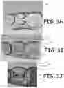 Fig. 07 - MODEL OBJECT FOR VISUALLY INDICATING OVER AND UNDER REMOVALS OF MATERIAL DURING A PROCEDURE