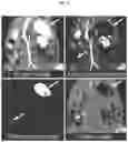 Fig. 20 - Encapsulated gas or partial vacuum CT contrast material