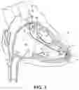 Fig. 02 - Compact implantable medical device and delivery device