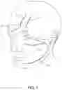 Fig. 02 - Device for the transcutaneous electrical stimulation of the trigeminal nerve