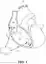 Fig. 02 - Pacing mode switching and rate response limit in a ventricular pacemaker
