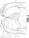 Fig. 02 - Intravenous phrenic nerve stimulation lead