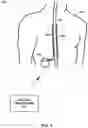 Fig. 02 - Closed-loop therapy stimulation response to patient adjustment