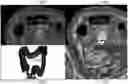 Fig. 01 - 3-D VIRTUAL ENDOSCOPY RENDERING