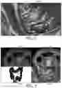 Fig. 03 - 3-D VIRTUAL ENDOSCOPY RENDERING