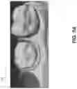 Fig. 06 - Dental model superimposition using clinical indications