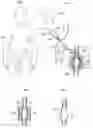 Fig. 02 - Device for treatment of aneurysm