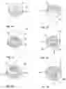 Fig. 06 - Anchoring assembly for anchoring a rod to a bone or a vertebra