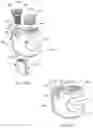 Fig. 28 - Systems and methods for surgical procedures using band clamp implants and tensioning instruments