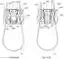 Fig. 36 - Systems and methods for surgical procedures using band clamp implants and tensioning instruments