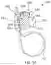 Fig. 41 - Systems and methods for surgical procedures using band clamp implants and tensioning instruments