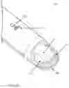 Fig. 22 - RF energy enabled tissue debridement device