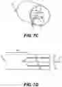 Fig. 08 - Devices and methods for protecting against neuromas