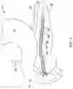 Fig. 02 - Pancreatic stent with drainage feature