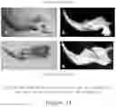 Fig. 15 - BONE-LIKE PROSTHETIC IMPLANTS
