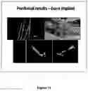 Fig. 16 - BONE-LIKE PROSTHETIC IMPLANTS