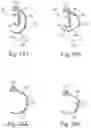 Fig. 17 - Cushion for a respiratory mask assembly
