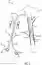 Fig. 03 - Proximally seperable catheters and associated methods