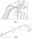 Fig. 02 - STYLET WITH IMPROVED THREADABILITY